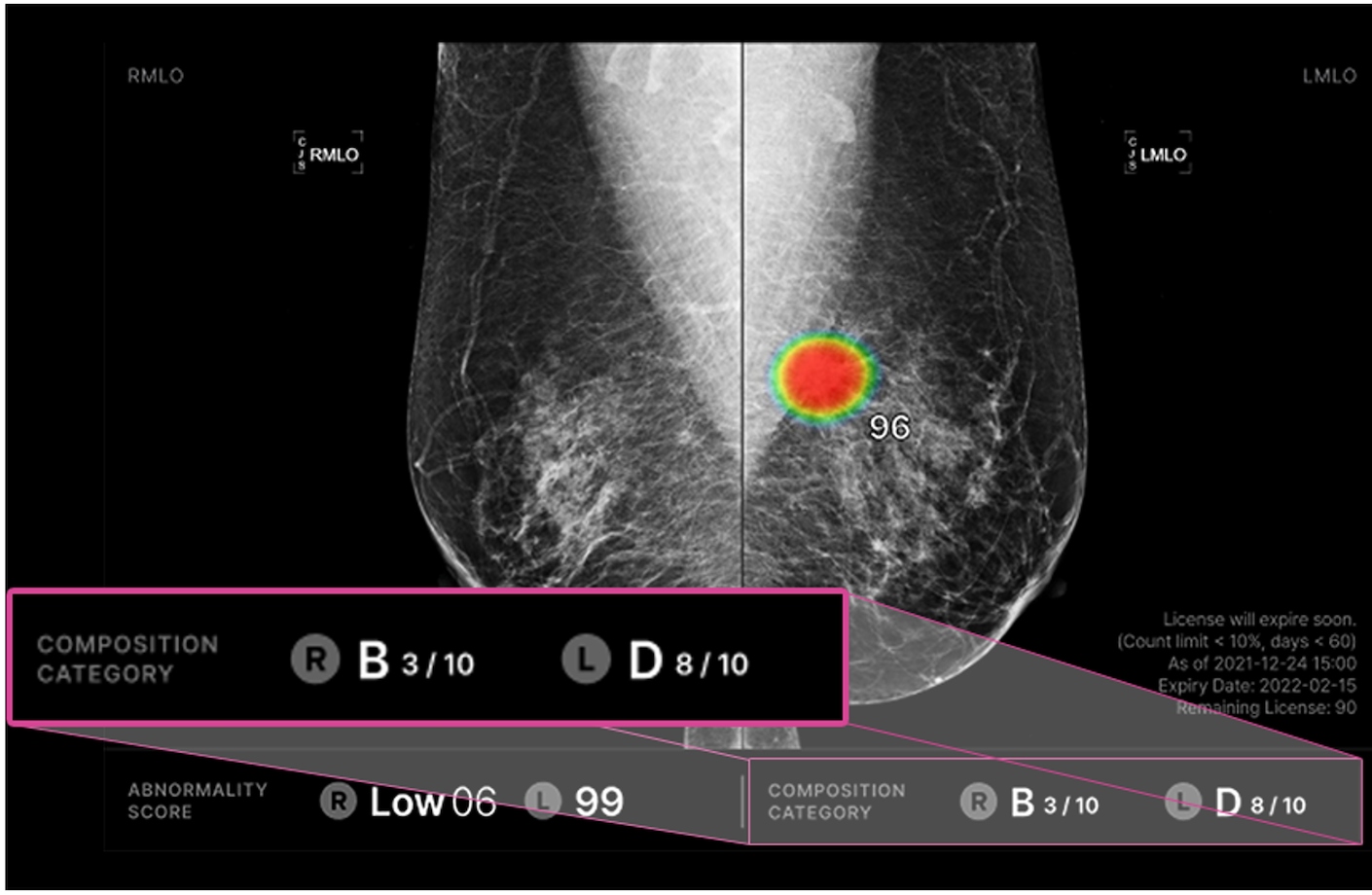 양측 유방 치밀도 확인