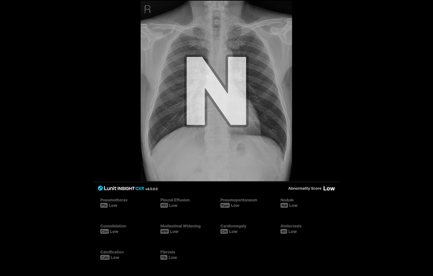 정상 케이스 판독보조